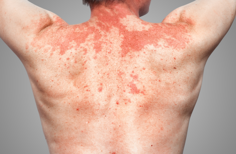 piros, bőrkiütéses hát