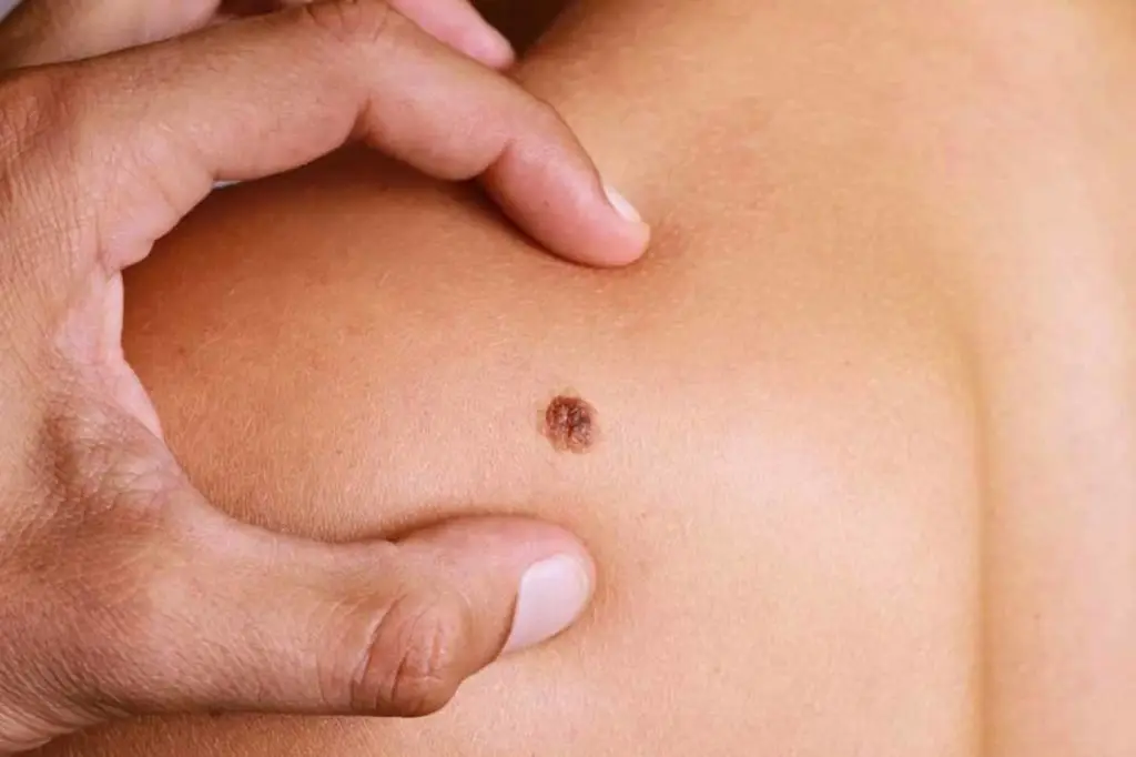melanoma felismerése