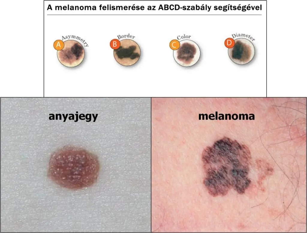 melanoma felismerése