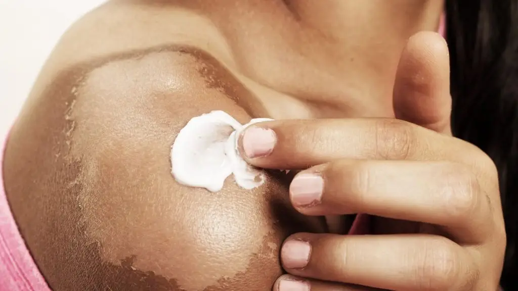 naptej napégés
